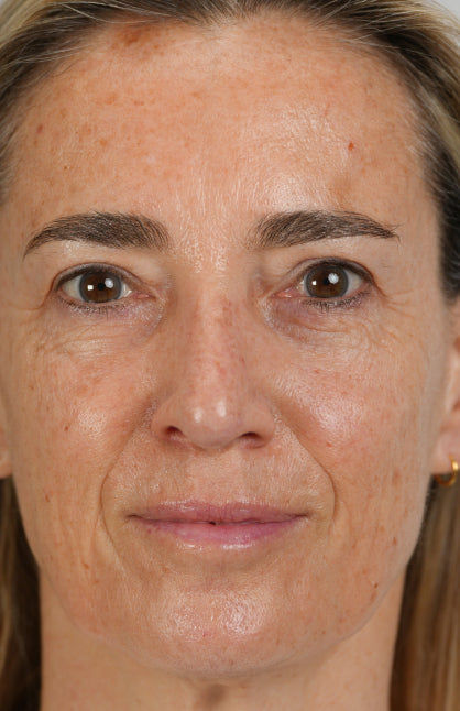 After — Longevity Activator Treatment
