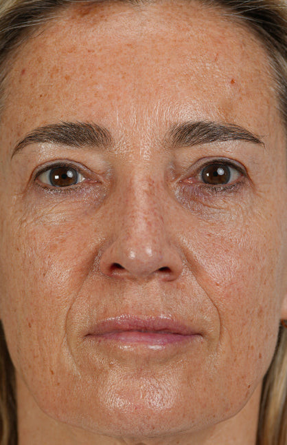 Before — Longevity Activator Treatment