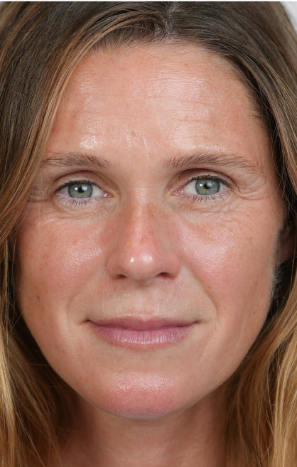 After — Biopeeling Treatment