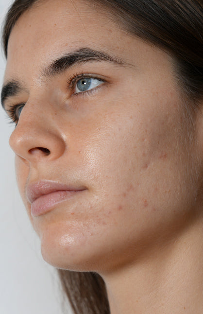 Before — Corrective and Anti-Imperfection Treatment